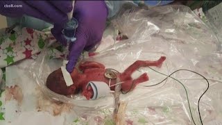 World’s smallest surviving baby born in San Diego [upl. by Ikcim]