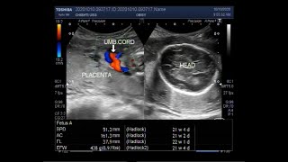 Ultrasound Video showing extreme of Oligohydromnios is Anhydramnios [upl. by Egief]