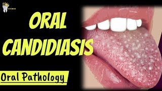 ORAL PATHOLOGY  ORAL CANDIDIASIS [upl. by Branen909]