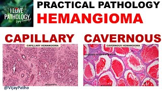 HEMANGIOMA capillary amp Cavernous Clinical features amp Morphology [upl. by Ahsele]