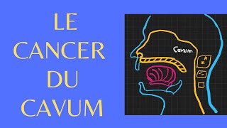 Le cancer du cavum en 5 points [upl. by Laundes]