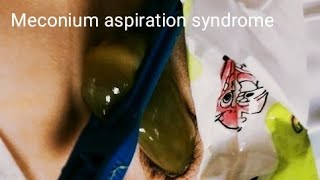 Meconium Aspiration Syndrome  Pediatrics [upl. by Brocklin842]