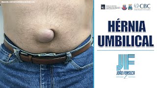 HÉRNIAS ABDOMINAIS Parte 5 UMBILICAL 👨🏽‍⚕️🚑 Joao Fonseca Cir Geral [upl. by Eittocs]