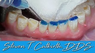 Bonding Worn Anterior Teeth  Dental Minute with Dr Steven T Cutbirth DDS [upl. by Ainollopa]