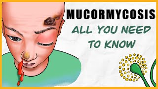 Mucormycosis microbiology types signs amp symptoms diagnosis treatment [upl. by Adnir]