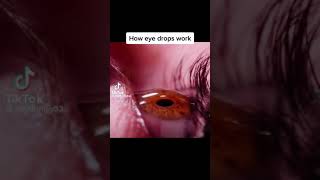 Doctor Removes 23 Contact Lenses From Patients Eye [upl. by Bolitho]