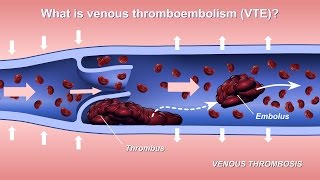 Understanding and Diagnosing Venous Thromboembolism VTE [upl. by Vilberg809]