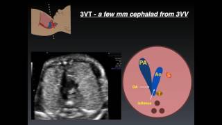 Three Vessel Tracheal View A Review of Normal and Abnormal Findings [upl. by Ekusuy]